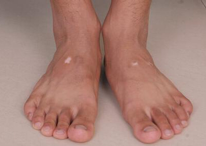 脚上有白斑要怎么治疗好呢