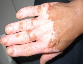 手部白癜风病发的原因有哪些? 