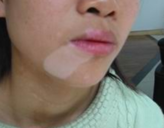 天津治疗白癜风医院：脸部白癜风的护理方法